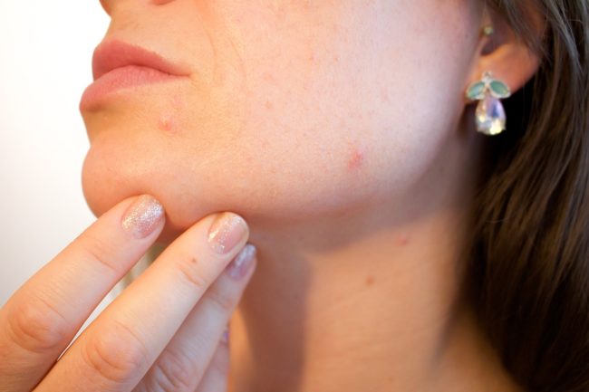 last van acne Last van acne? Botox kan de oplossing zijn!